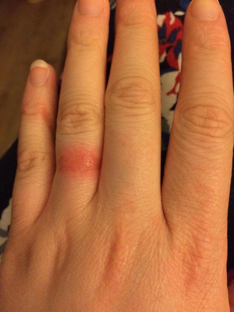 Wedding ring allergic reaction