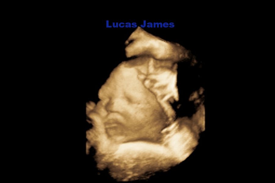 32 weeks, ultrasound. 3D. facial features!! | BabyCenter